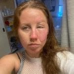 فتاة تحترق بسبب مشروب